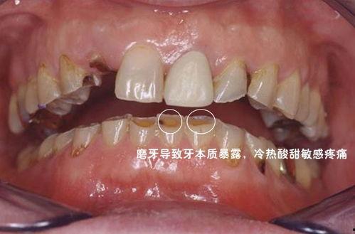 成人修磨牙视频大全,成人修磨牙技巧与案例大盘点